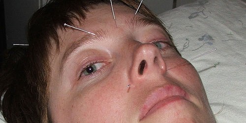 Acupuncture for Bell's Palsy