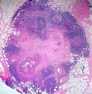 Healthy lymph nodes