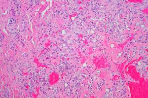 Hemangioma spine facts