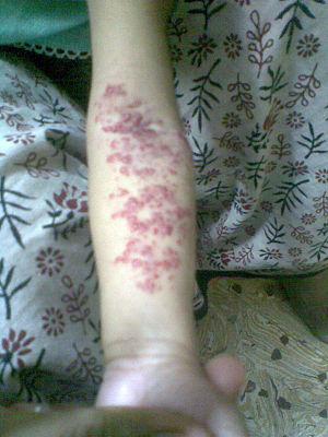 Hemangioma treatment options