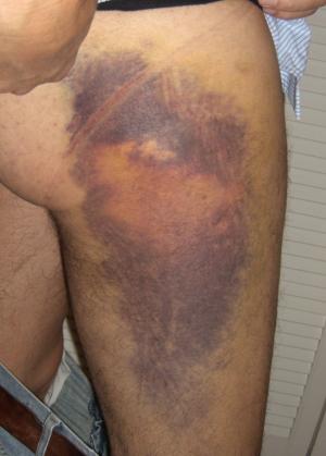 Hematoma after surgery