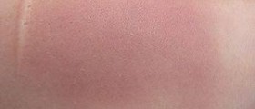 Hematoma in leg