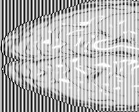 Hemispherectomy: Brain surgery to remove part of the brain