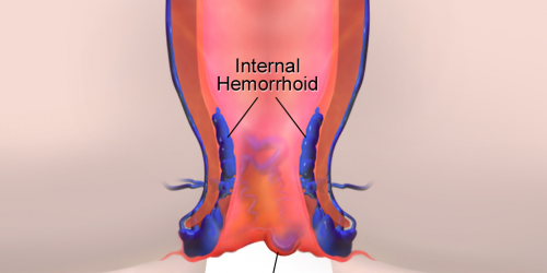 Hemorrhoids: A Pain In The Butt