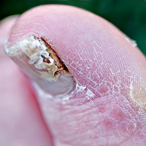 Herbs for nail fungus