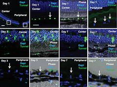 Hereditary eye disease
