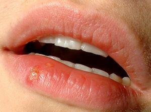 Herpes cure - is there a cure for herpes ?