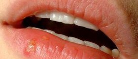 Herpes cure - is there a cure for herpes ?