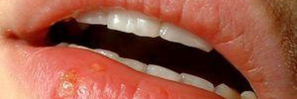 Herpes cure - is there a cure for herpes ?