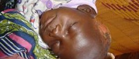 Herpes encephalitis prognosis
