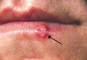 Herpes natural treatments are crucial for your health