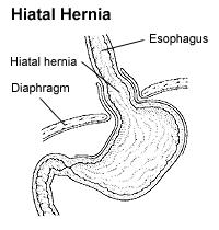 Hiatal hernia and acid reflux