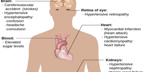 Signs and Symptoms of High Blood Pressure