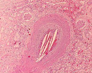 High cholesterol risks