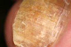 Home remedy for toenail fungus