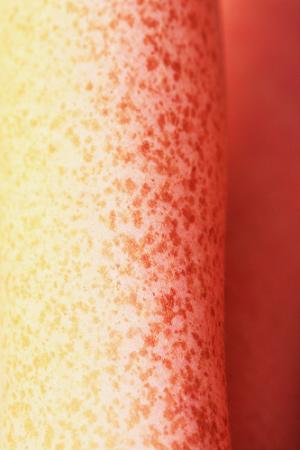 Home treatment for freckles
