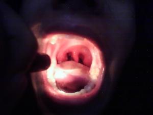 Home treatment for tonsillitis