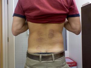 Homeopathic remedy for lower back pain