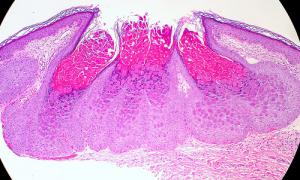 Homeopathic remedy for molluscum contagiosum
