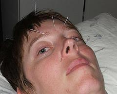 How does acupuncture work?