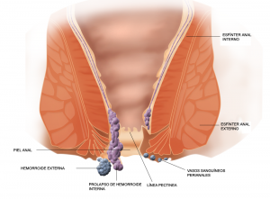 How to cure external hemorrhoids