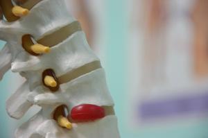 How to cure herniated disc pain