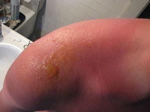How to get rid of sunburn