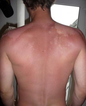 How to prevent sunburn peeling