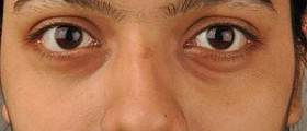 How to reduce aging signs under your eyes