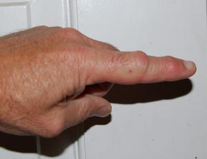 How to treat a bee or wasp sting
