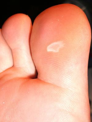 How to treat a blister on toe