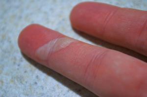 How to treat a burn blister