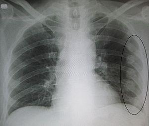 How to treat a fractured sternum