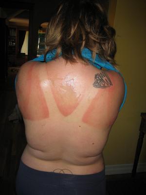 How to treat a sunburn with blisters