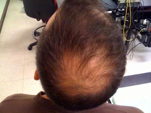 How to treat alopecia hair loss