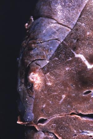 How to treat an abscess