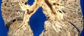 How to treat chronic obstructive pulmonary disease