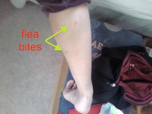 How to treat flea bites | General center | SteadyHealth.com