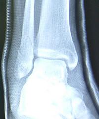 How to treat sternal fractures