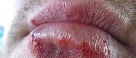 HSV encephalitis symptoms