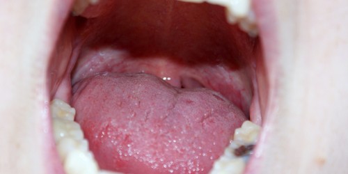The Changing Face of Oral Cancer
