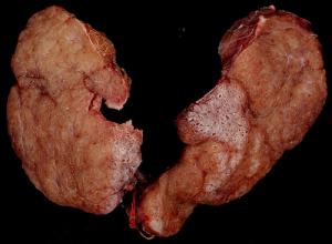 Hyperactive thyroid symptoms