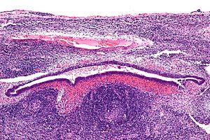 Hysterectomy: Surgical procedure for endometriosis