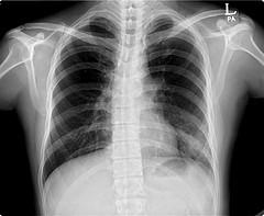Idiopathic scoliosis - The most common form of the scoliosis