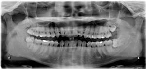 Impacted wisdom teeth