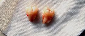 Impacted wisdom teeth: diagnosis and treatment