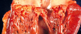 Infective Endocarditis: Treatment for Heart Disease