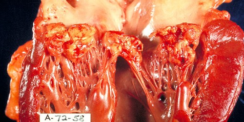 Infective Endocarditis: Treatment for Heart Disease