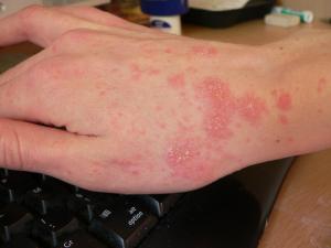 Information about cures for scabies