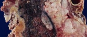 Information about Mesothelioma ?